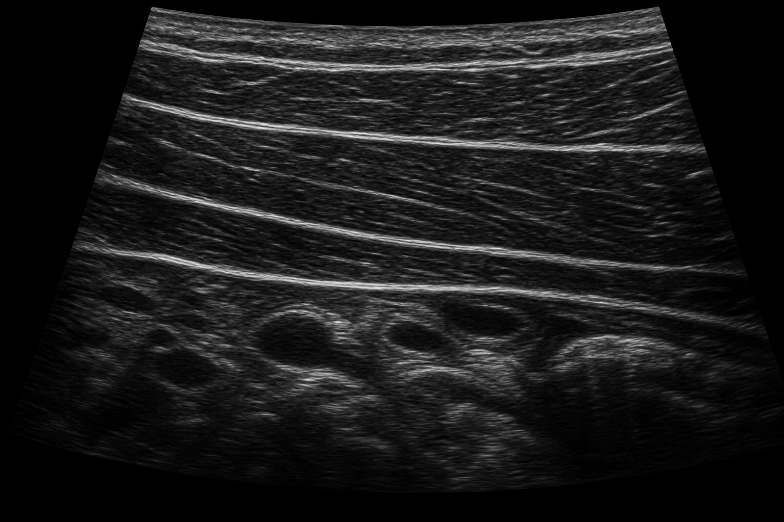 Imagem ultrassonográfica educacional simulada da parede abdominal lateral, sem marcações.